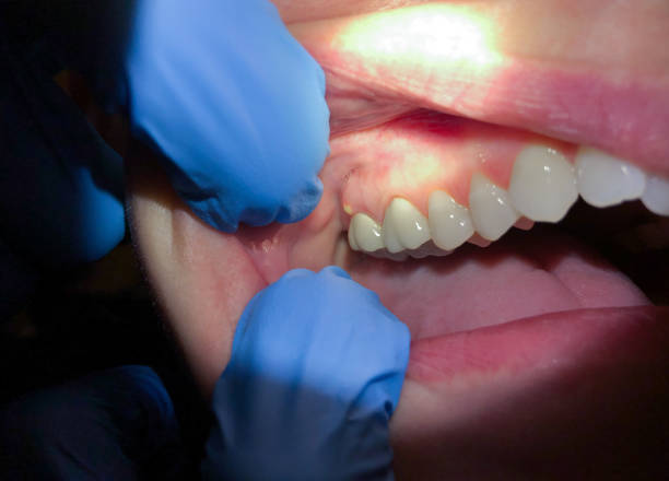 Best Emergency Care for Gum Disease in Harriman, NY