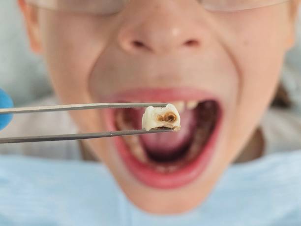 Best Knocked-Out Tooth (Avulsed Tooth) Treatment in Harriman, NY